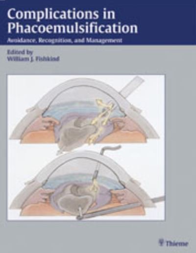Complications in Phacoemulsification - William J. Fishkind - 图书 - Thieme Medical Publishers - 9780865779594 - 2001年12月1日